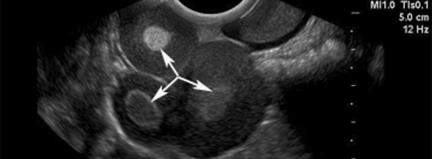 İyi Huylu Kistik Teratom - Yumurtalık Tümörü