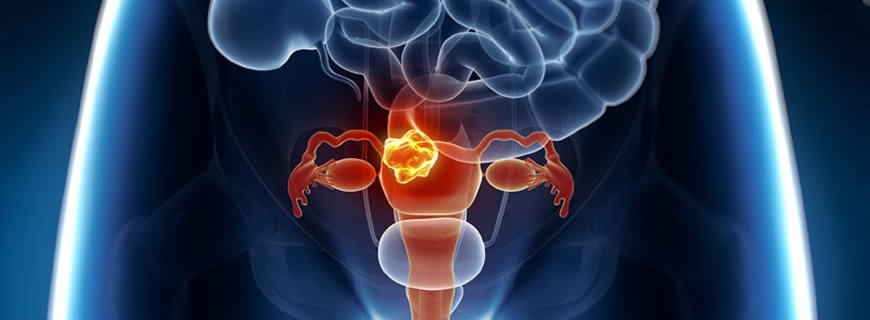 Fibroma - Yumurtalık Tümörü, Yumurtalık Kisti