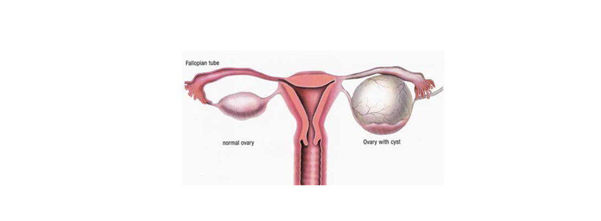 Korpus Luteum Kistleri